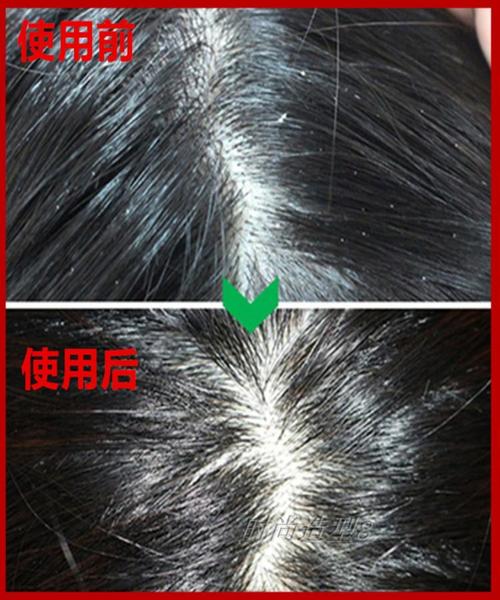 去屑止痒最有效的方法(去屑止痒最有效的方法是什么)