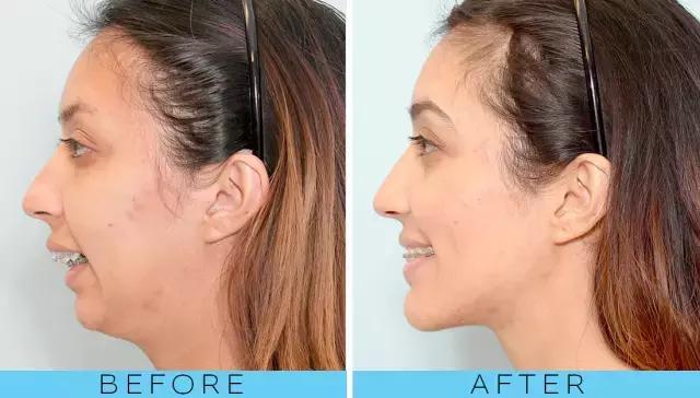 整容后变好看的五位女明星(那些默默变美的明星们不是整容)(20)