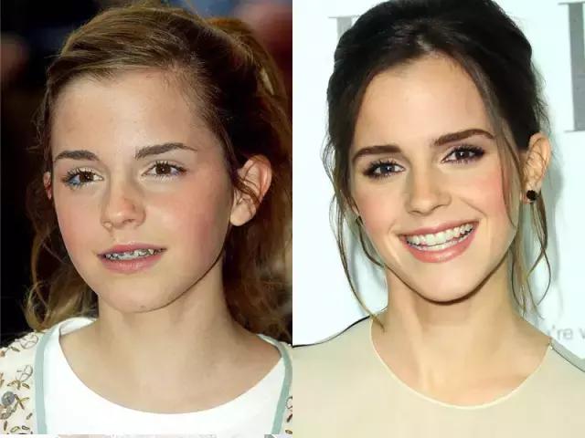 整容后变好看的五位女明星(那些默默变美的明星们不是整容)(14)