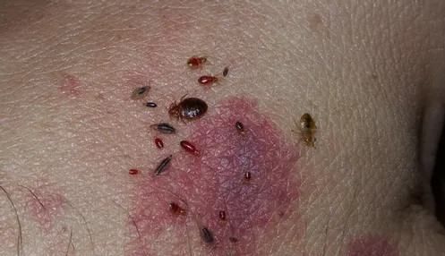 宿舍有臭虫怎么消灭,宿舍床上有臭虫怎样可以彻底消灭图1