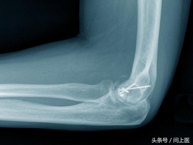 骨折病人护理措施及注意事项(骨折患者的日常护理)(1)