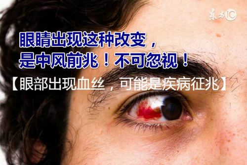 眼睛也会中风吗（眼睛中风的解释）