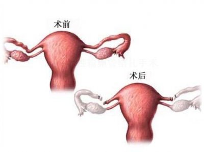 ​女性结扎手术图片 女性结扎手术全过程（附图）
