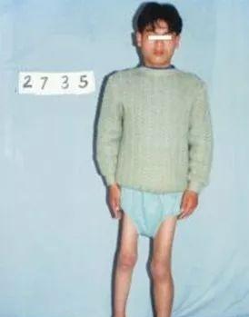 糖丸爷爷走了!给孩子服用过期脊灰疫苗,你们对得起他吗