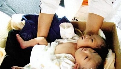 ​2011年，四川孕妇生下中国第一例“双头女婴”，之后怎么样了？