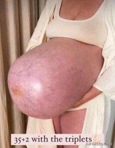 ​惊人！三胞胎妈妈晒孕期孕肚照，网友：母亲太伟大了！